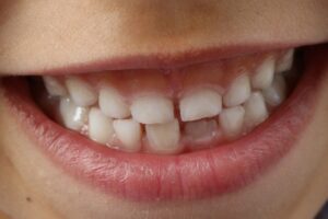 Jak mieć zawsze piękne zęby? Unikaj chorób zębów, dbaj o profilaktykę
